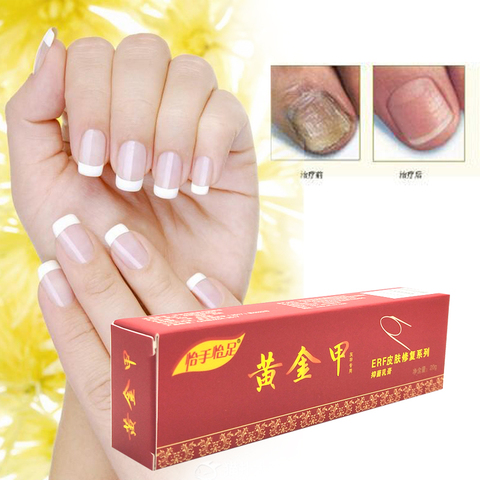 Buy Online Nail Fungus Treatment Onychomycosis Paronychia Anti Fungal Nail Infection Good Result Chinese Herbal Toe Nail Treatment Alitools