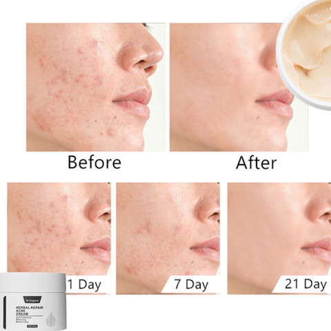Acne Treatment Face Cream Blackhead Repair Oil Control Shrink Pores Scar Whitening Moisturizer Skin Care Korean Cosmetics ► Photo 1/6