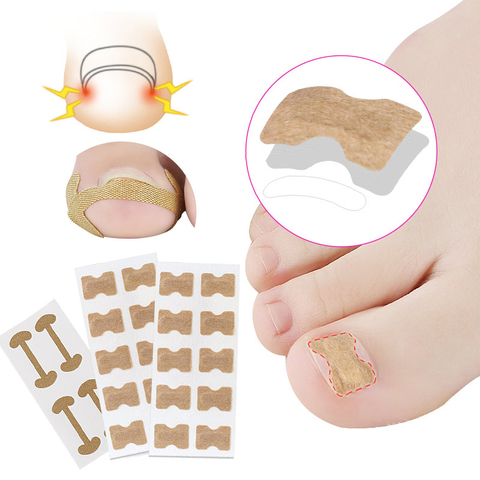 1Set Ingrown Toenail Corrector Sticker Paronychia Treatment Corrector Pedicure Foot Orthodontic Toe Thumb Nail Care Patches ► Photo 1/6