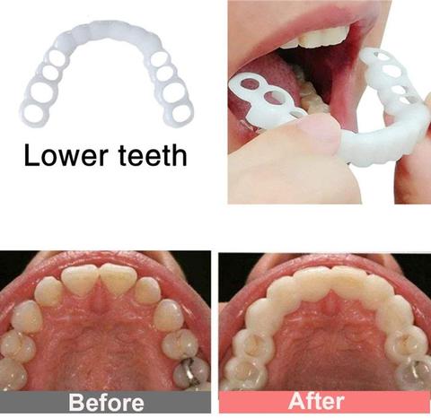 Cubierta para dientes postizos para blanqueamiento dental, accesorio de belleza para la parte superior de los dientes, con cierre a presión, de silicona, apta para sonrisa, 1 Juego ► Foto 1/6