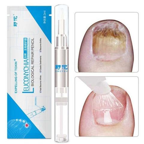 1pc de hongos tratamiento pluma Anti hongo infección reparación biológica de la solución nutritiva de aceite de 3ml restaura saludable las uñas de los pies ► Foto 1/6