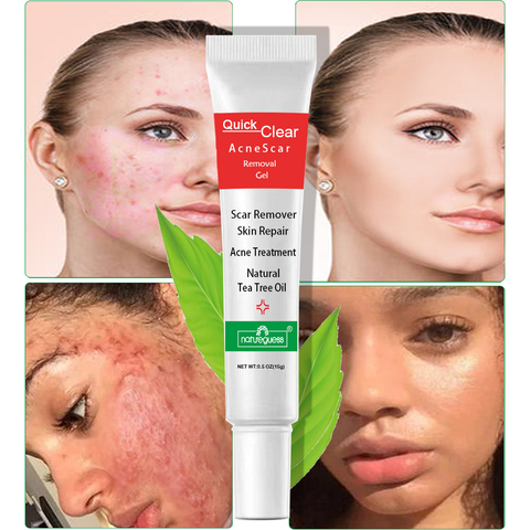 Tratamiento para el acné, crema facial para eliminar cicatrices, puntos negros, Gel de reparación, Control de aceite, reducción de poros, blanqueamiento, cuidado de la piel, Cosméticos Coreanos ► Foto 1/6