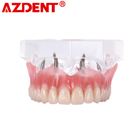 Dental sobredentadura implantes dentales dientes modelo Demo sobredentadura de restauración con implantes superior ► Foto 1/6