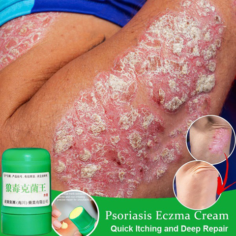 Piel crema para la Psoriasis de la piel para la piel problemas chino de ungüento antibacteriano ► Foto 1/6