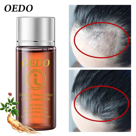 20 ml Ginseng el crecimiento del cabello esencia para prevenir la pérdida de cabello líquido daño tratamiento de reparación de pelo de DENSO rápido restauración el crecimiento del cabello ► Foto 1/6