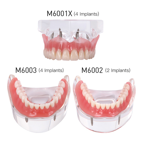 Implante Dental dientes modelo Interior extraíble Mandibular Demo sobredentadura con implantes superior/inferior por diente estudio pedagógico ► Foto 1/6