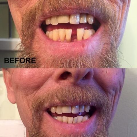 Carillas dentales para dientes, carillas de sonrisa postizas, carillas removibles en dientes, sonrisa temporal, kit de reparación de Color Natural ► Foto 1/5