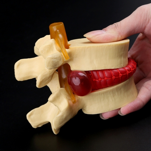 Herramienta de enseñanza médica para hernia de disco Lumbar de columna anatómico con franqueo gratuito modelo de accesorios médicos ► Foto 1/6