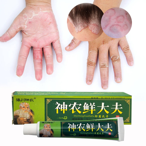15g Natural chino medicina de hierbas bacterias Anti crema psoriasis eczema ungüento tratamiento de alta calidad de crema ► Foto 1/6