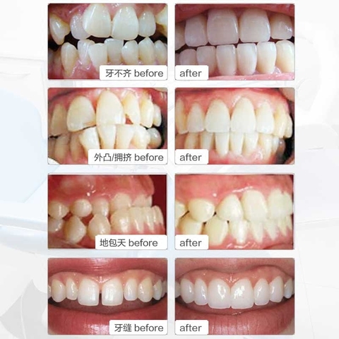Nuevo adulto Dental ortodoncia Dental, blanqueamiento de dientes órtesis Dental ortodoncia retenedores dispositivo Anti ronquido ► Foto 1/6