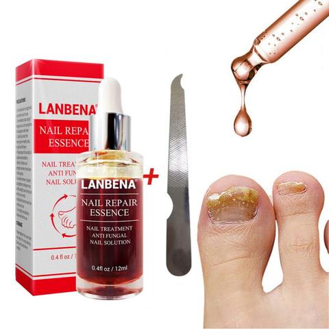 LANBENA-suero nutritivo para el cuidado de la piel de los pies, suero de esencia para reparación de uñas, tratamiento para uñas con hongos ► Foto 1/6