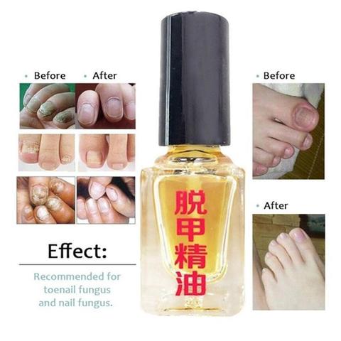 Aceite esencial para la eliminación de hongos en las uñas, líquido para el tratamiento de las uñas con onicomicosis, brillante ► Foto 1/6