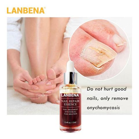 LANBENA-tratamiento antihongos para uñas, lápiz para uñas, eliminación del pie, Fungu, tratamiento hidratante para Repiar las uñas de los pies, TSLM1 ► Foto 1/6