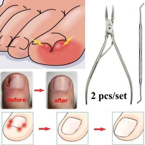 Ingrown-cortauñas para pedicura para el cuidado de los pies, cortaúñas para corrección de uñas, producto para eliminar la piel muerta, pedicura ► Foto 1/6