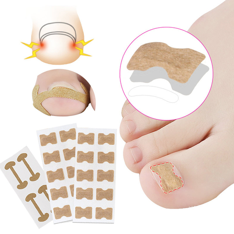 1Set encarnada Corrector para uñas de los pies de la paroniquia tratamiento Corrector para pedicura pie ortodoncia dedo pulgar del pie de cuidado de uñas parches ► Foto 1/6