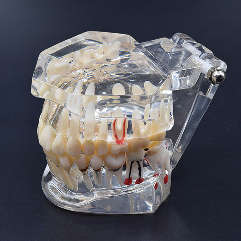 Accessoires dentaires, modèle de dents de haute qualité, enseignement des maladies des Implant dentaires, étude ► Photo 1/6