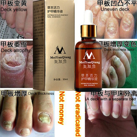 Fongique Original traitement des ongles Essence ongle et pied blanchissant orteil ongles champignon ► Photo 1/6