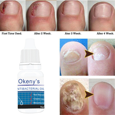 Tuer 99.9% bactéries soin des ongles traitement ongles fongique huile Onychomycosis Paronychia Anti fongique Infection des ongles réparation traitement 5ml ► Photo 1/1