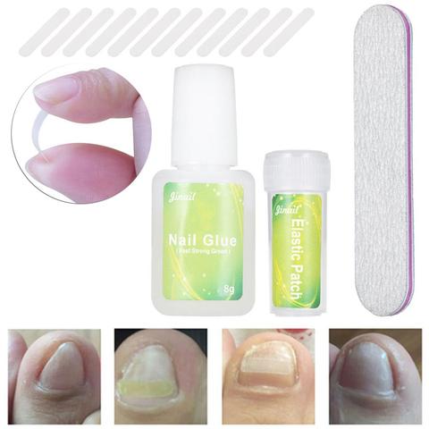 Ensemble d'outils de Correction pour ongles enroulés, 12 pièces/bouteille, Patch élastique pour pédicure, Patch élastique lissant et Clip avec colle ► Photo 1/6