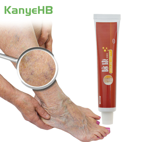 Traitement de 1 pièces pour les varices phytothérapie chinoise pour l'élimination de l'angiite variqueuse phlébite veines de jambe pommade S034 ► Photo 1/6