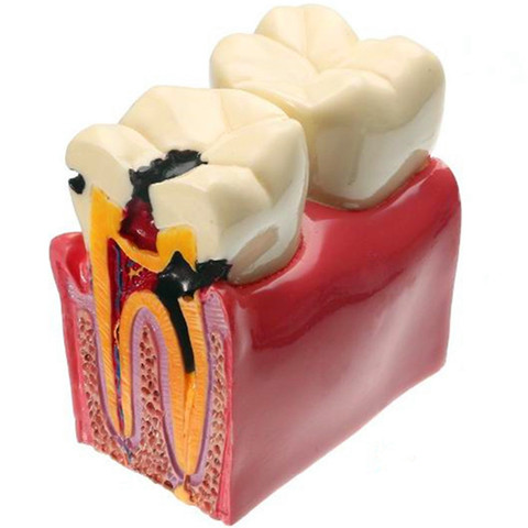 Модель зубных материалов лабораторные зубы 1 шт. 6 раз, модели для изучения кариеса, для изучения и исследований стоматолога ► Фото 1/5